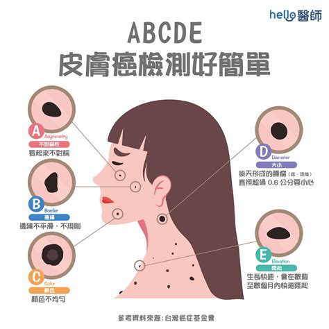 皮膚癌|皮膚長痣、長斑是皮膚癌前兆？皮膚癌初期4大症狀快。